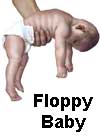 Floppy baby syndrom